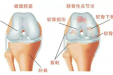 重燃“膝”望——PRP治疗膝关节骨性关节炎