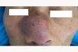 协同联动,精准施治!一例鼻面部严重感染合并重症糖尿病患者的救治纪实→