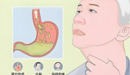 “一口饭的折磨”成为过去式！POEM手术，为贲门失弛缓症患者“疏通路，解心忧”