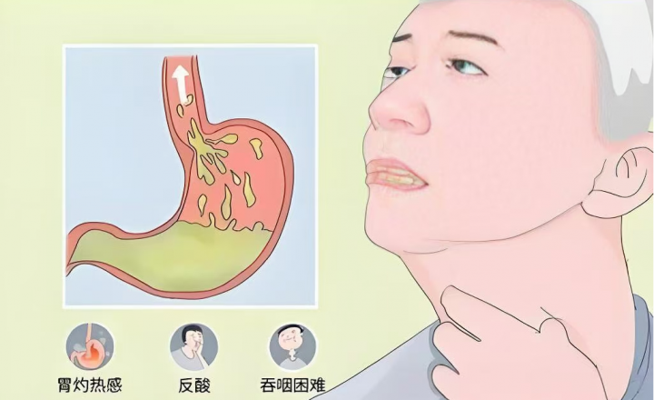 “一口饭的折磨”成为过去式！POEM手术，为贲门失弛缓症患者“疏通路，解心忧”