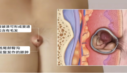 屁股后面总长“痘”？小心是“藏毛窦”在作怪！