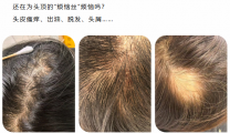 头皮油、头发掉、还发痒？试试这个“新解法”！