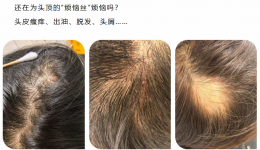 头皮油、头发掉、还发痒？试试这个“新解法”！