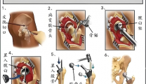【健康科普】人工髋关节置换术：为磨损的髋关节按下“重启键”