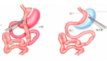 健康体重科普系列三 | 肥胖手术：是治病，不是“减肥捷径”