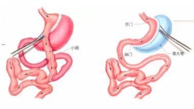 健康体重科普系列三 | 肥胖手术：是治病，不是“减肥捷径”